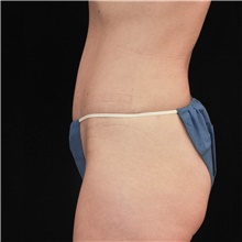 Tummy Tuck After Photo by Judith Gurley, M.D., F.A.C.S.; Chesterfield, MO - Case 49108