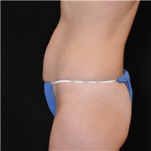 Tummy Tuck Before Photo by Judith Gurley, M.D., F.A.C.S.; Chesterfield, MO - Case 49108