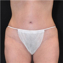 Tummy Tuck After Photo by Judith Gurley, M.D., F.A.C.S.; Chesterfield, MO - Case 49109