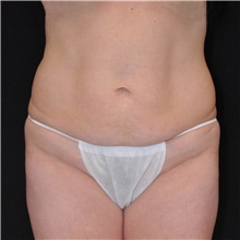 Tummy Tuck Before Photo by Judith Gurley, M.D., F.A.C.S.; Chesterfield, MO - Case 49109