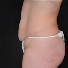 Tummy Tuck Before Photo by Judith Gurley, M.D., F.A.C.S.; Chesterfield, MO - Case 49109