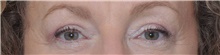 Eyelid Surgery After Photo by Judith Gurley, M.D., F.A.C.S.; Chesterfield, MO - Case 49110