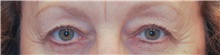 Eyelid Surgery Before Photo by Judith Gurley, M.D., F.A.C.S.; Chesterfield, MO - Case 49110