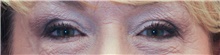 Eyelid Surgery After Photo by Judith Gurley, M.D., F.A.C.S.; Chesterfield, MO - Case 49111