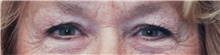 Eyelid Surgery Before Photo by Judith Gurley, M.D., F.A.C.S.; Chesterfield, MO - Case 49111