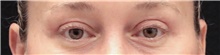 Eyelid Surgery After Photo by Judith Gurley, M.D., F.A.C.S.; Chesterfield, MO - Case 49112