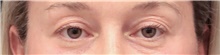 Eyelid Surgery Before Photo by Judith Gurley, M.D., F.A.C.S.; Chesterfield, MO - Case 49112