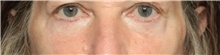 Eyelid Surgery After Photo by Judith Gurley, M.D., F.A.C.S.; Chesterfield, MO - Case 49113