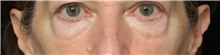 Eyelid Surgery Before Photo by Judith Gurley, M.D., F.A.C.S.; Chesterfield, MO - Case 49113