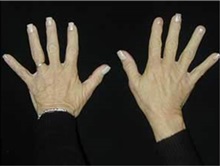 Hand Surgery After Photo by Craig Mezrow, MS, MD, FACS; Bala Cynwyd, PA - Case 33989