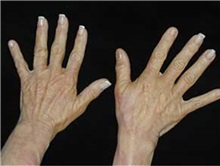 Hand Surgery Before Photo by Craig Mezrow, MS, MD, FACS; Bala Cynwyd, PA - Case 33989