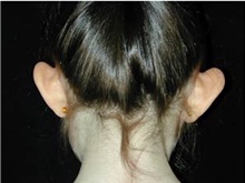 Ear Surgery Before Photo by Craig Mezrow, MS, MD, FACS; Bala Cynwyd, PA - Case 33994