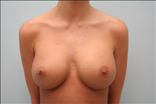 Breast Augmentation After Photo by G. Robert Meger, MD; Scottsdale, AZ - Case 24421