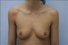 Breast Augmentation Before Photo by G. Robert Meger, MD; Scottsdale, AZ - Case 24421