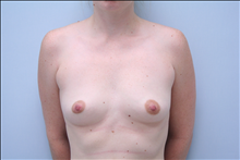 Breast Augmentation Before Photo by G. Robert Meger, MD; Scottsdale, AZ - Case 24422