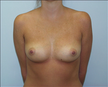 Breast Augmentation Before Photo by G. Robert Meger, MD; Scottsdale, AZ - Case 24423