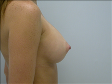 Breast Augmentation After Photo by G. Robert Meger, MD; Scottsdale, AZ - Case 24423