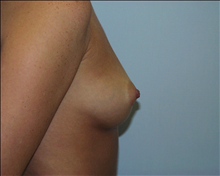 Breast Augmentation Before Photo by G. Robert Meger, MD; Scottsdale, AZ - Case 24423