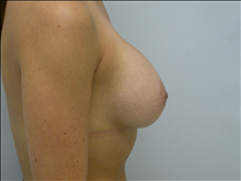 Breast Augmentation After Photo by G. Robert Meger, MD; Scottsdale, AZ - Case 24424