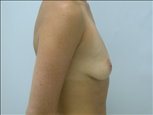 Breast Augmentation Before Photo by G. Robert Meger, MD; Scottsdale, AZ - Case 24424
