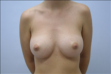 Breast Augmentation After Photo by G. Robert Meger, MD; Scottsdale, AZ - Case 24425