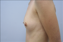 Breast Augmentation Before Photo by G. Robert Meger, MD; Scottsdale, AZ - Case 24425