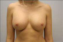 Breast Augmentation After Photo by G. Robert Meger, MD; Scottsdale, AZ - Case 24426