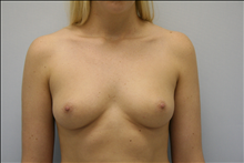 Breast Augmentation Before Photo by G. Robert Meger, MD; Scottsdale, AZ - Case 24426