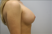 Breast Augmentation After Photo by G. Robert Meger, MD; Scottsdale, AZ - Case 24426