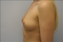 Breast Augmentation Before Photo by G. Robert Meger, MD; Scottsdale, AZ - Case 24426