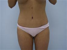 Tummy Tuck After Photo by G. Robert Meger, MD; Scottsdale, AZ - Case 27639