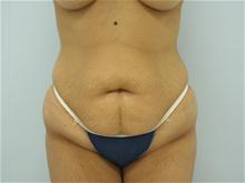 Tummy Tuck Before Photo by G. Robert Meger, MD; Scottsdale, AZ - Case 27639