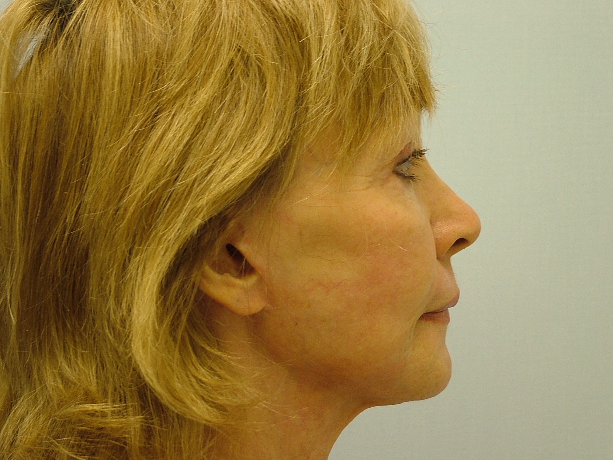 Facelift Before and After Photos by G. Robert Meger, MD