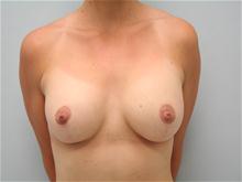 Breast Lift After Photo by G. Robert Meger, MD; Phoenix, AZ - Case 27642