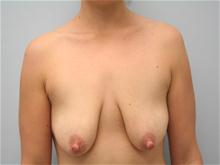 Breast Lift Before Photo by G. Robert Meger, MD; Phoenix, AZ - Case 27642