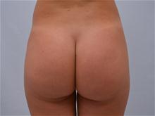 Buttock Lift with Augmentation After Photo by G. Robert Meger, MD; Scottsdale, AZ - Case 28085