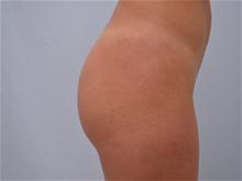 Buttock Lift with Augmentation After Photo by G. Robert Meger, MD; Scottsdale, AZ - Case 28085