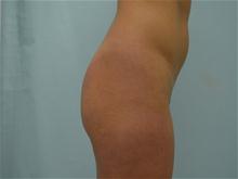Buttock Lift with Augmentation Before Photo by G. Robert Meger, MD; Scottsdale, AZ - Case 28085