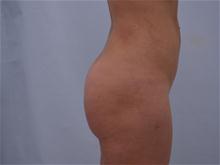 Buttock Lift with Augmentation After Photo by G. Robert Meger, MD; Scottsdale, AZ - Case 28086