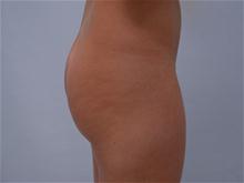 Buttock Lift with Augmentation Before Photo by G. Robert Meger, MD; Scottsdale, AZ - Case 28086