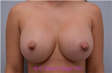Breast Augmentation After Photo by G. Robert Meger, MD; Phoenix, AZ - Case 33001