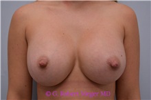 Breast Augmentation After Photo by G. Robert Meger, MD; Scottsdale, AZ - Case 33001