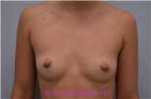 Breast Augmentation Before Photo by G. Robert Meger, MD; Scottsdale, AZ - Case 33001