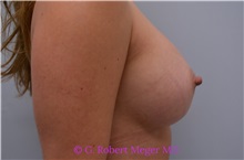Breast Augmentation After Photo by G. Robert Meger, MD; Scottsdale, AZ - Case 33001
