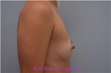 Breast Augmentation Before Photo by G. Robert Meger, MD; Scottsdale, AZ - Case 33001