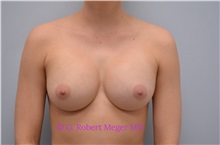 Breast Augmentation After Photo by G. Robert Meger, MD; Scottsdale, AZ - Case 33906