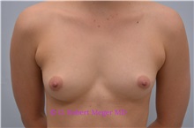 Breast Augmentation Before Photo by G. Robert Meger, MD; Phoenix, AZ - Case 33906