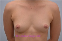 Breast Augmentation Before Photo by G. Robert Meger, MD; Scottsdale, AZ - Case 33906