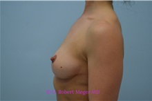 Breast Implant Removal After Photo by G. Robert Meger, MD; Scottsdale, AZ - Case 34329