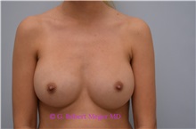 Breast Augmentation After Photo by G. Robert Meger, MD; Phoenix, AZ - Case 34691